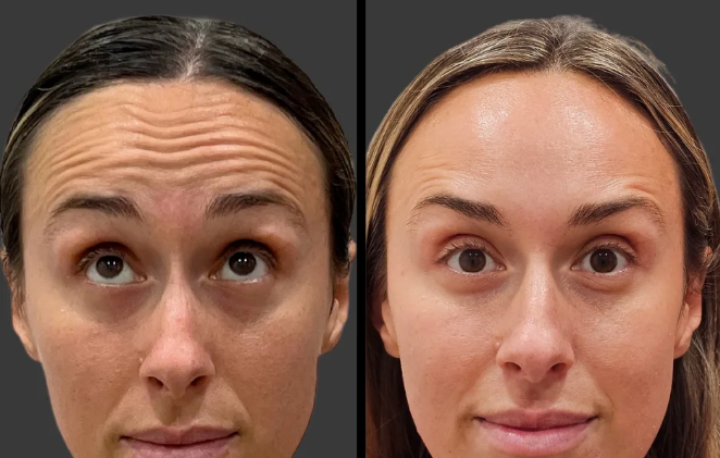 Botox
