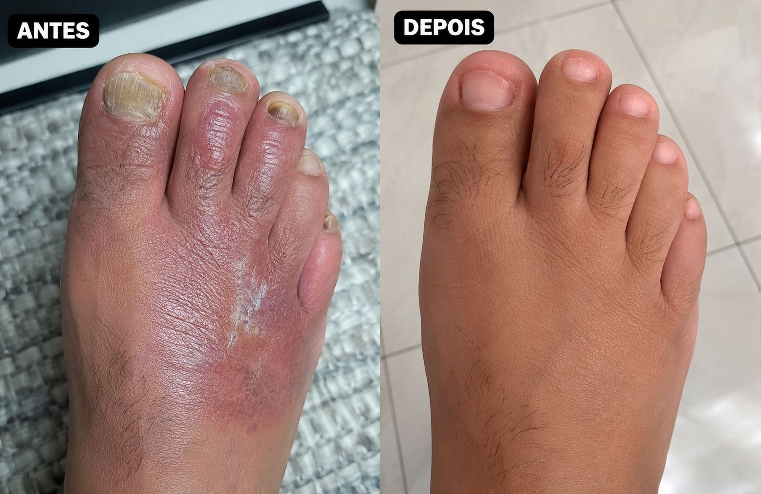 Tratamento de Micoses e Infecções