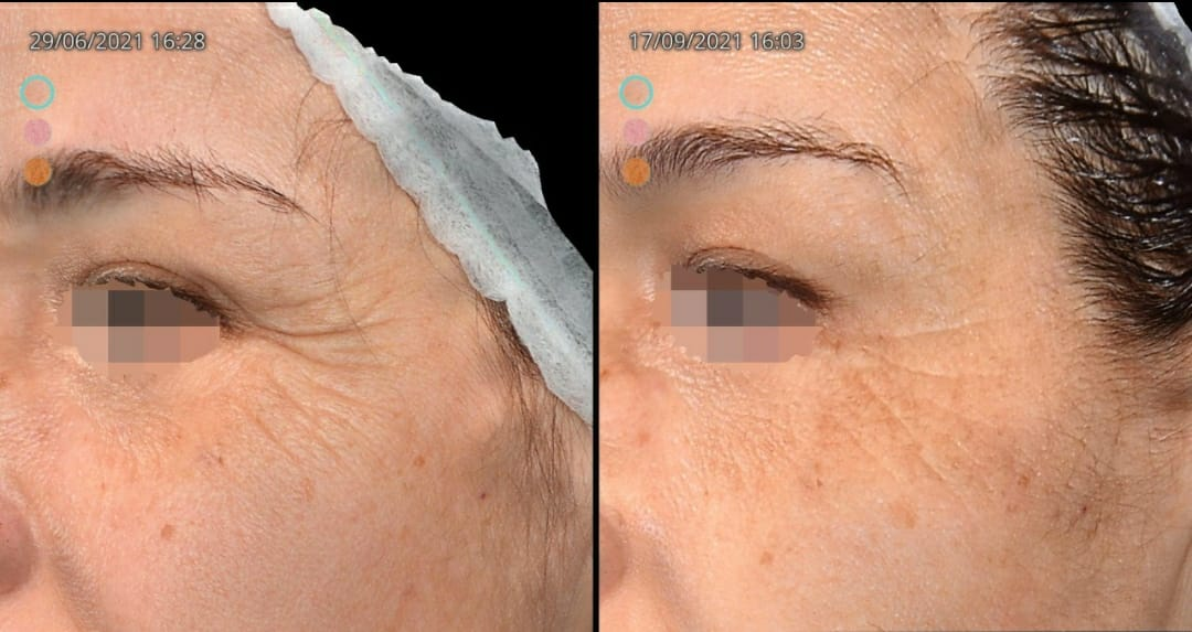 Antes e depois — Rejuvenescimento Periorbital