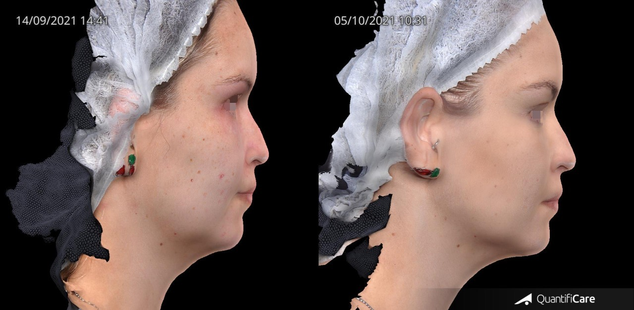 Antes e depois — Tratamento Facial — Perfil