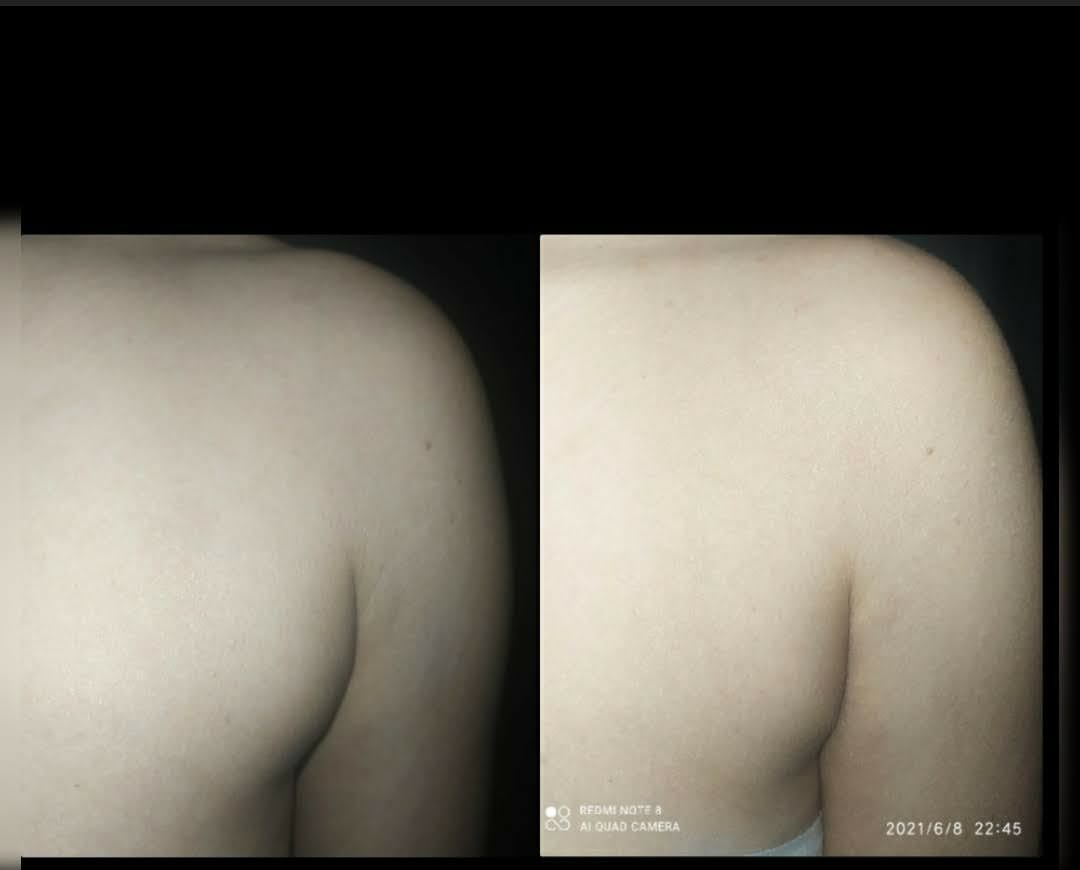 Antes e depois — Tratamento Corporal