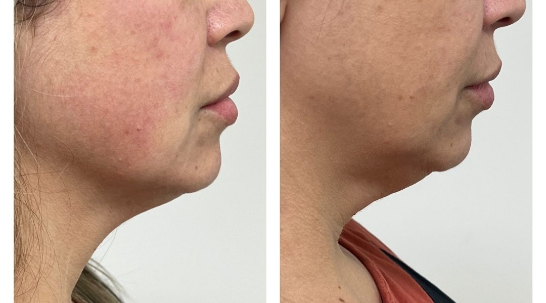 Antes e depois — Tratamento de Acne & Contorno