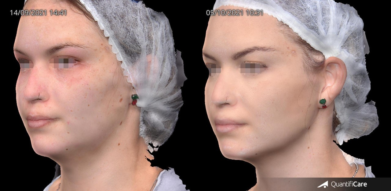 Antes e depois — Harmonização Facial
