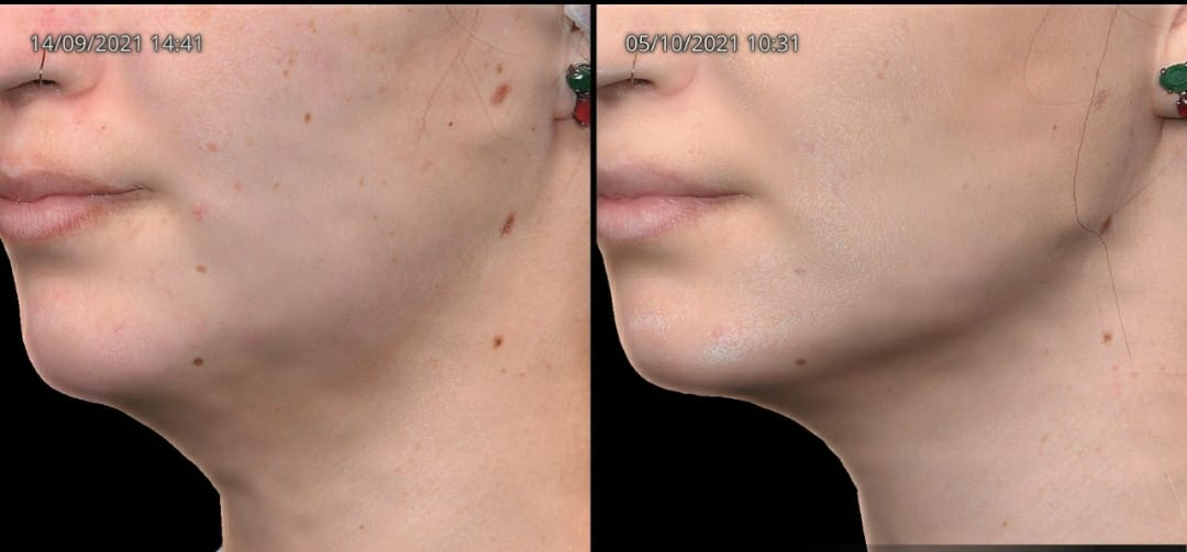 Antes e depois — Clareamento & Uniformização